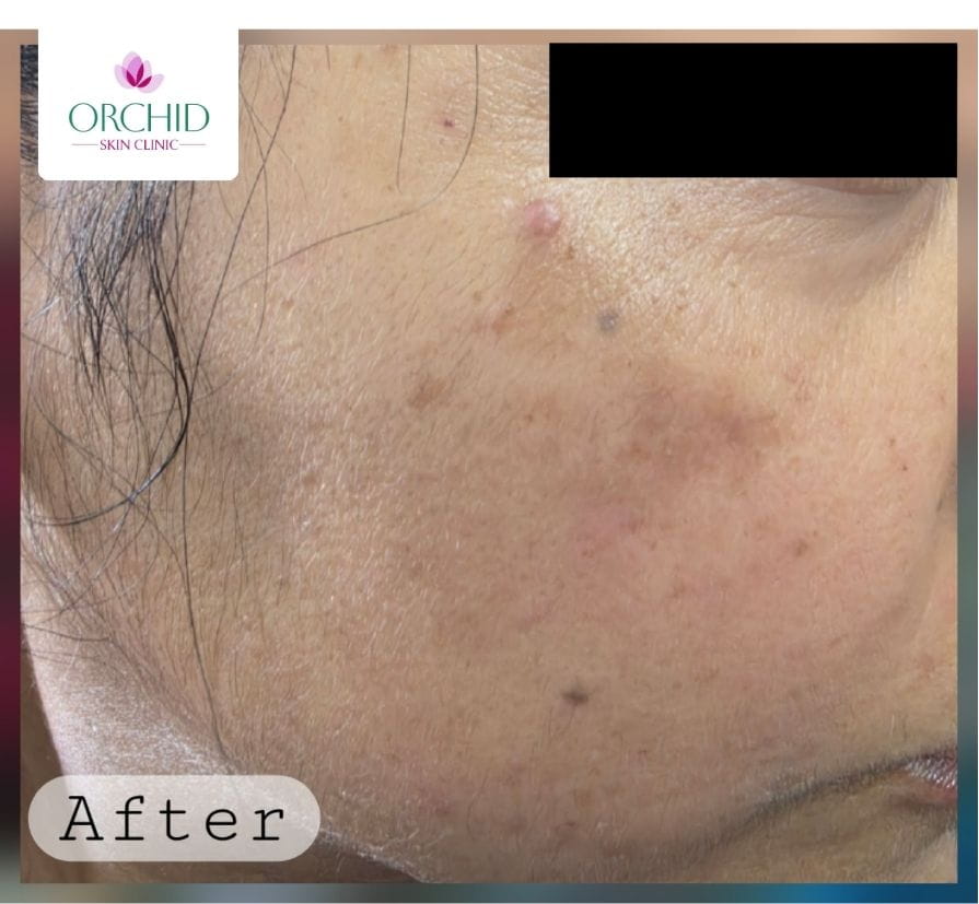 Post-procedure clearance after radiofrequency electrocautery for dermatosis papulosa nigra