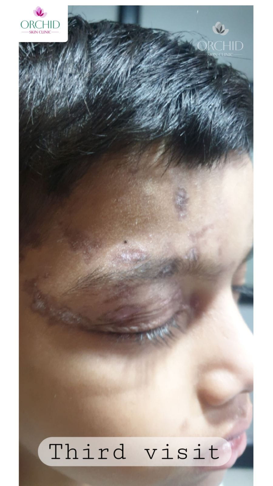 Third visit: Significant improvement with crust resolution