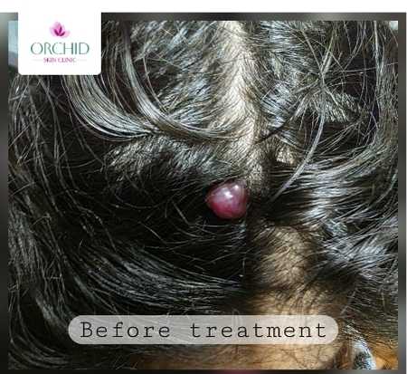 Nodular Cherry Angioma RF Treatment Case Study