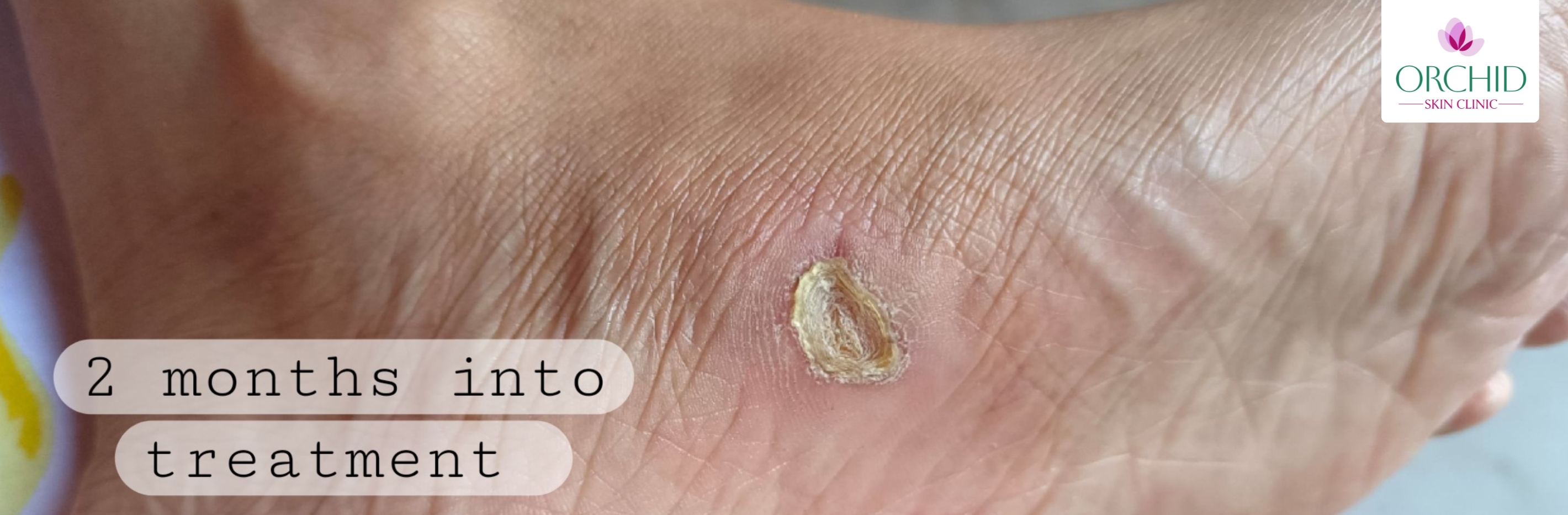 Plantar foot wound care