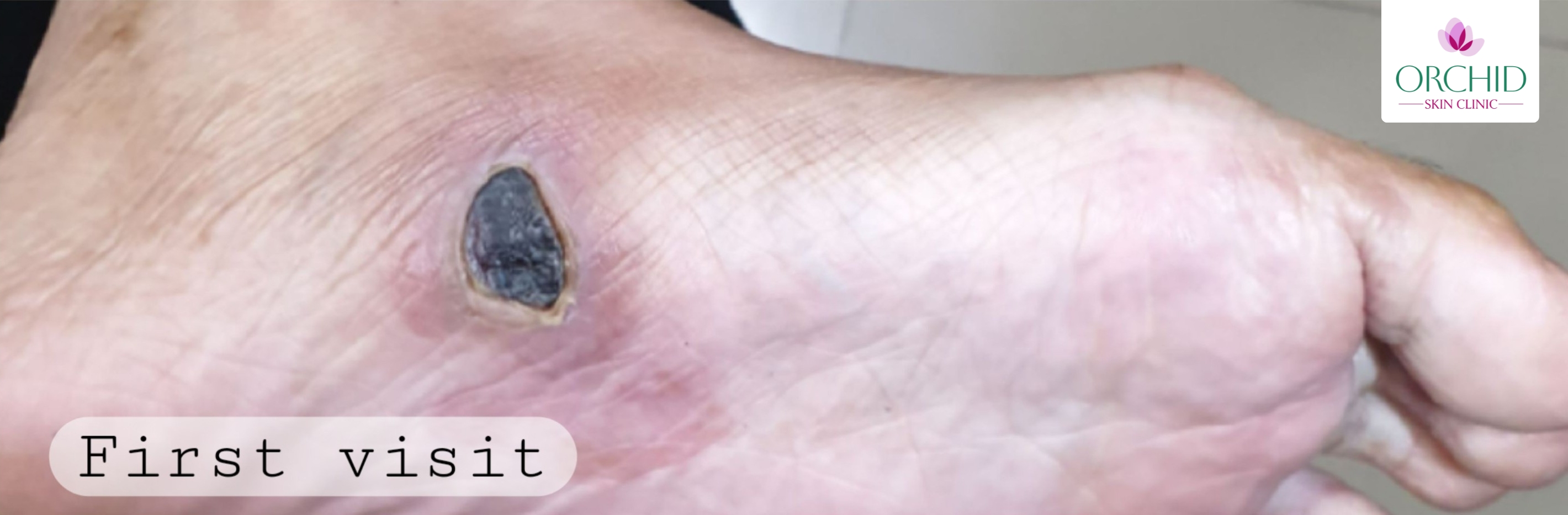 First visit wound appearance