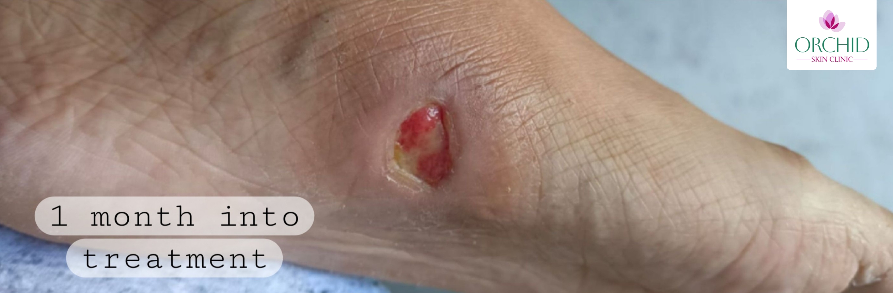 One month into treatment