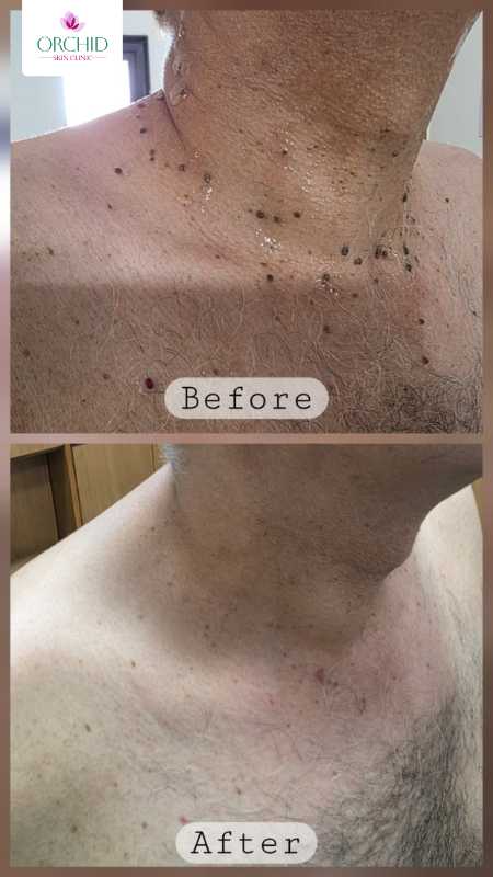 Radiofrequency Ablation of Acrochordons Case Study