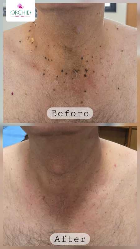 Radiofrequency Ablation Treatment Sample 2