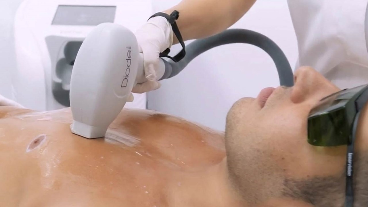 Laser hair reduction with Primelase
